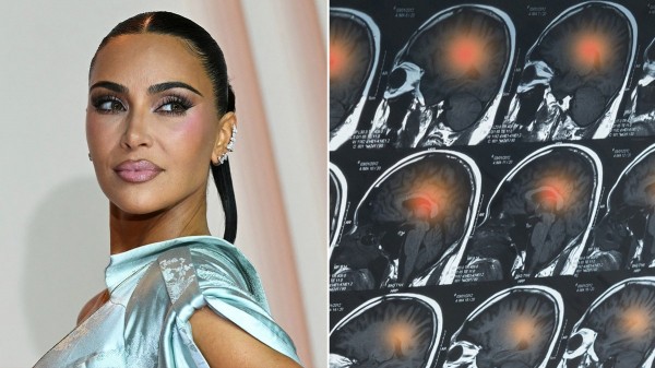 Kim Kardashian’s brain aneurysm scare: Doctors reveal warning signs to never ignore Kim Kardashian’s brain aneurysm scare: Doctors reveal warning signs to never ignore