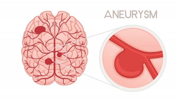 Kim Kardashian’s brain aneurysm scare: Doctors reveal warning signs to never ignore Kim Kardashian’s brain aneurysm scare: Doctors reveal warning signs to never ignore