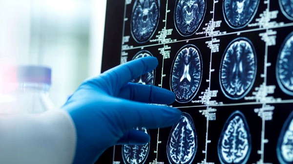 Men's brains shrink faster than women's; researchers explore Alzheimer's connection Men's brains shrink faster than women's; researchers explore Alzheimer's connection