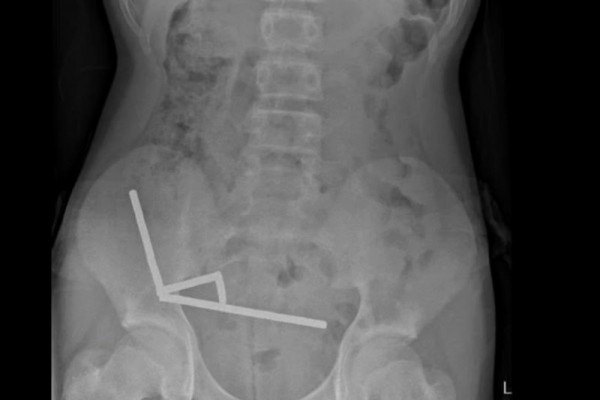 Teen boy swallows 80+ magnets, surgeons remove part of bowel Teen boy swallows 80+ magnets, surgeons remove part of bowel