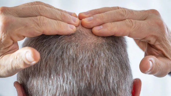 New baldness treatment shows dramatic hair-regrowth gains in major trial