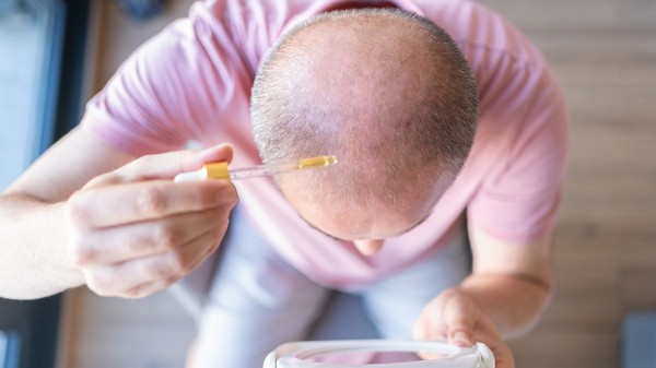 New baldness treatment shows dramatic hair-regrowth gains in major trial